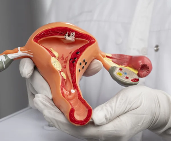 PCOS